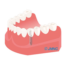 インプラント図